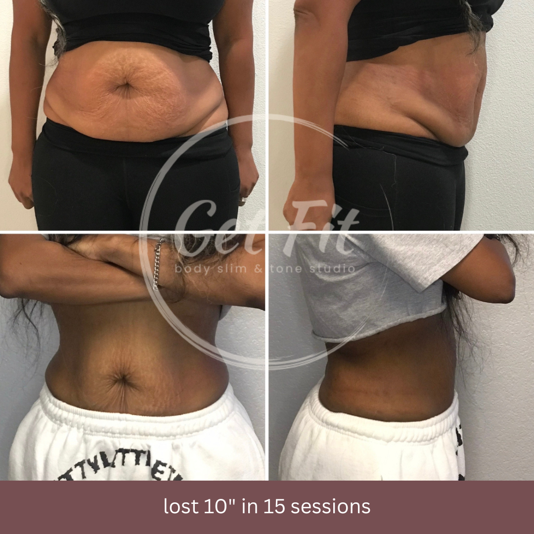 FREEZE OFF YOUR FAT!